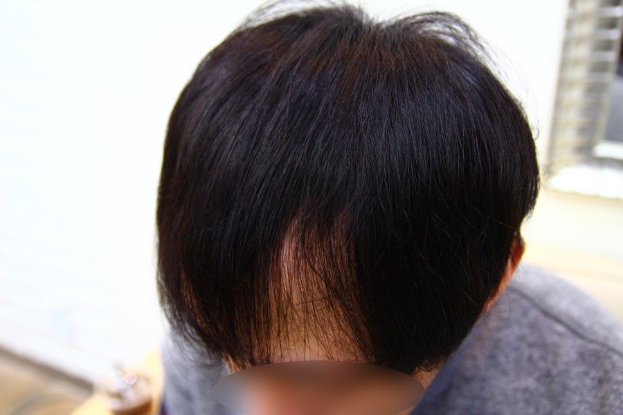 M자 탈모 헤어스타일 남자 붙임머리로 커버 동대문 붙임머리 전문점 머리공장 : 네이버 블로그