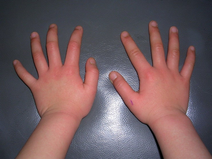 Typical Lesions Of Papular Purpuric Gloves And Socks vrogue.co
